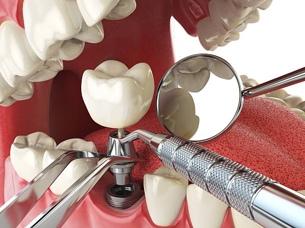 Best Emergency Root Canal Therapy in Glasgow, MO